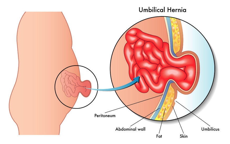 Umbilical and ventral hernia